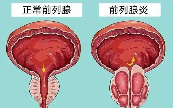 5,急性前列腺炎没有得到及时治疗,会演变成慢性前列腺炎,此时细菌