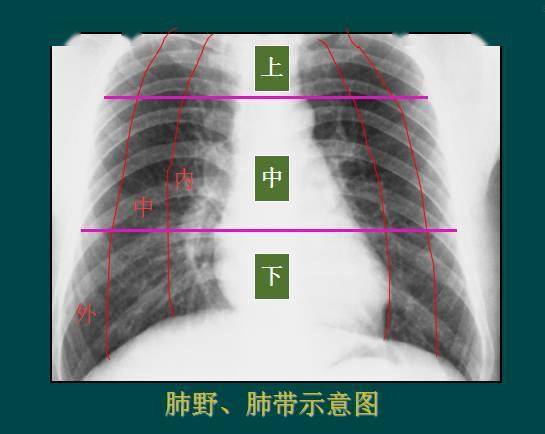 肺纹理为自肺门向肺野呈放射状分布的树枝状阴影,它主要是肺动脉的