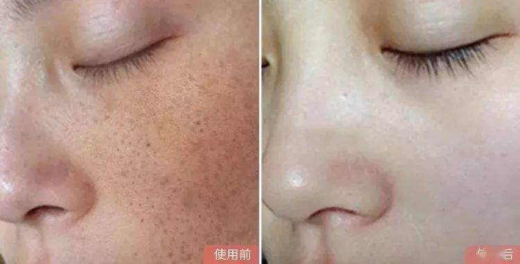 如何让脸上的疤痕消失 c234041fb7a04cac9f7025eba771188b.jpeg