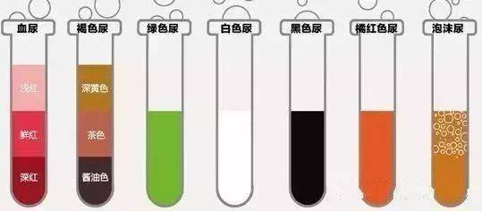 尿液发黄,异味预示着什么?成年人健康小便的6个标准