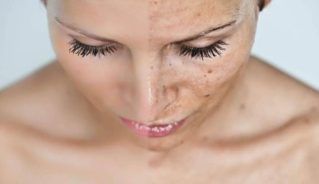 皮肤|一杯奶茶钱就能做的医美，做完立刻后悔！