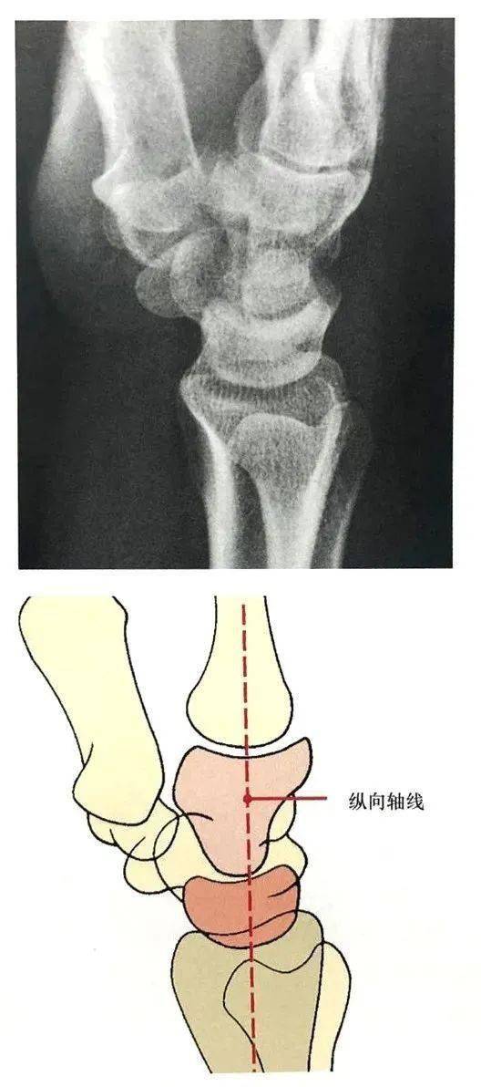 腕关节脱位及其x片阅读技巧