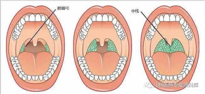 °肿大的扁桃体:超过咽腭弓,但未达到咽后壁中线.如图 4 所示.图 3.