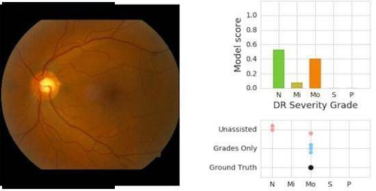 算法|谷歌糖尿病视网膜病变AI检测算法，已在印度和泰国医院应用