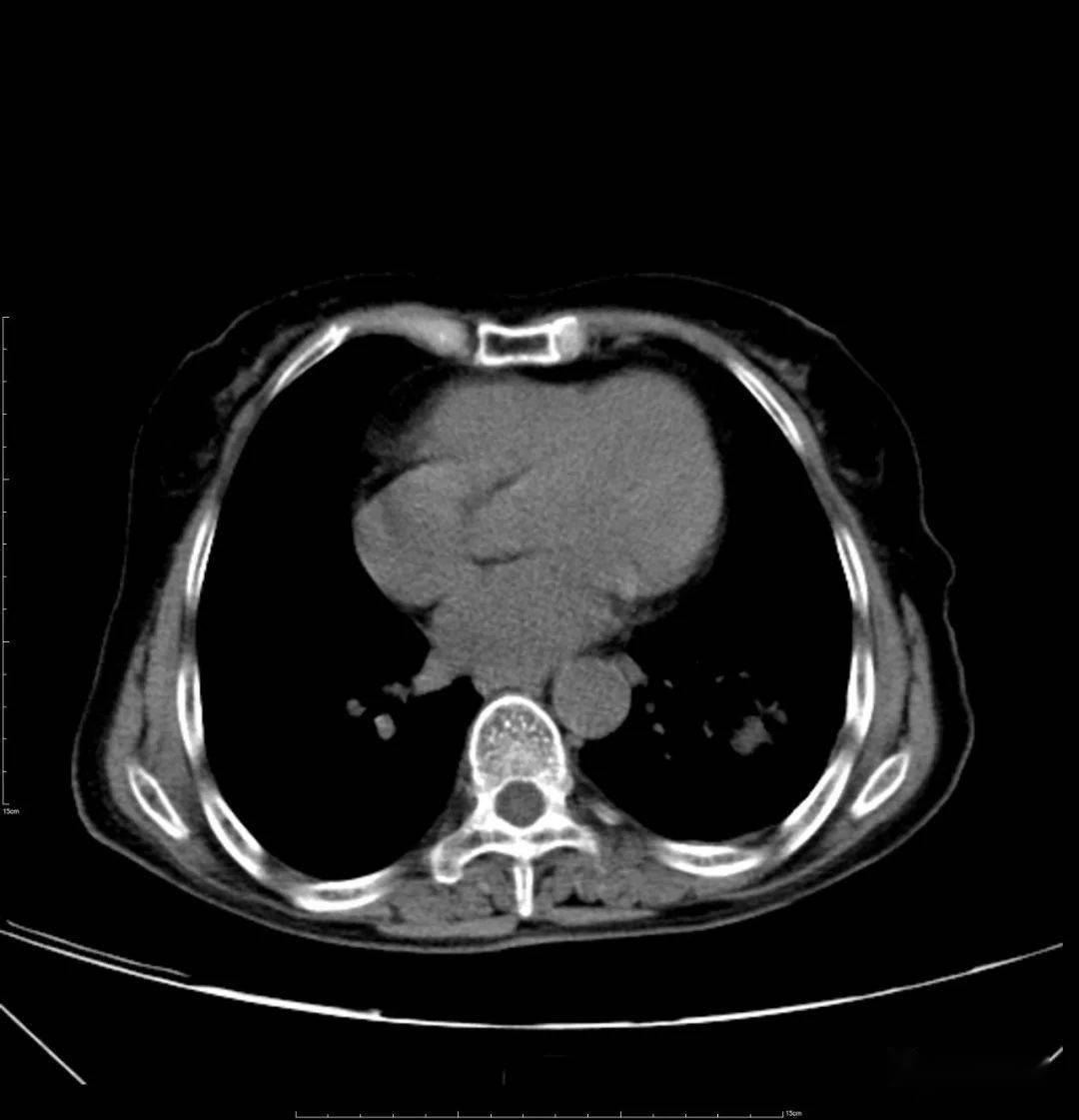 胸部ct平扫示左下肺占位——肺癌