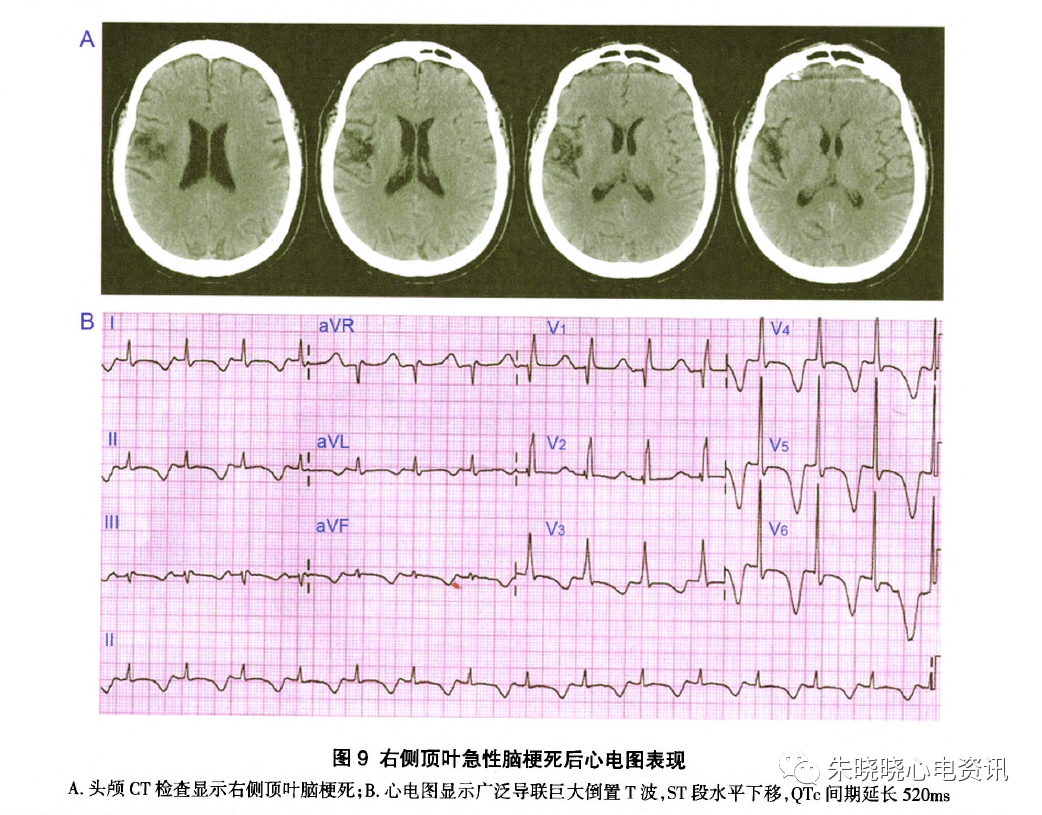 急危重症小脑梗死手术治疗比较-病例分享 - 脑医汇 - 神外资讯 - 神介资讯