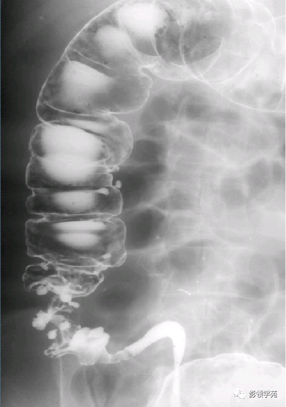 结肠多发憩室