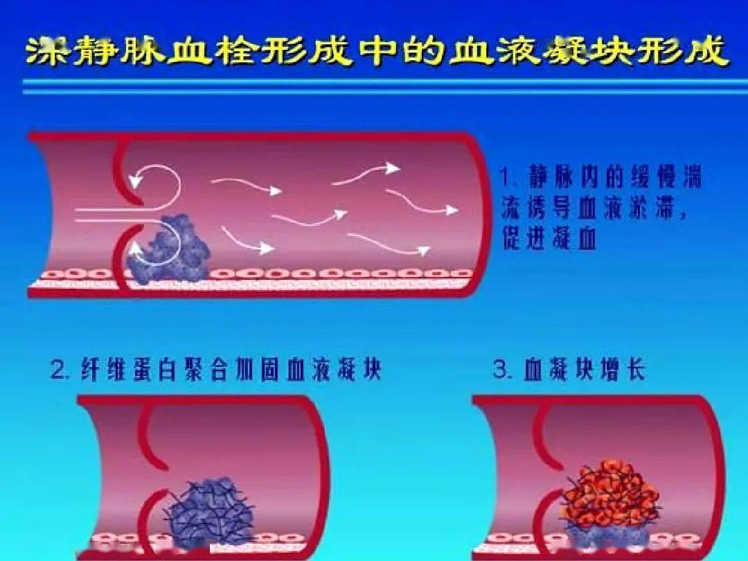 4招反"栓"计远离动静脉血栓