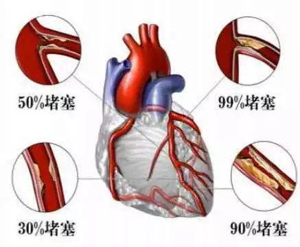 是什么原因引起急性心肌梗死 6f0f5346ed5f4ed7b9675a467f4cfddc.jpeg