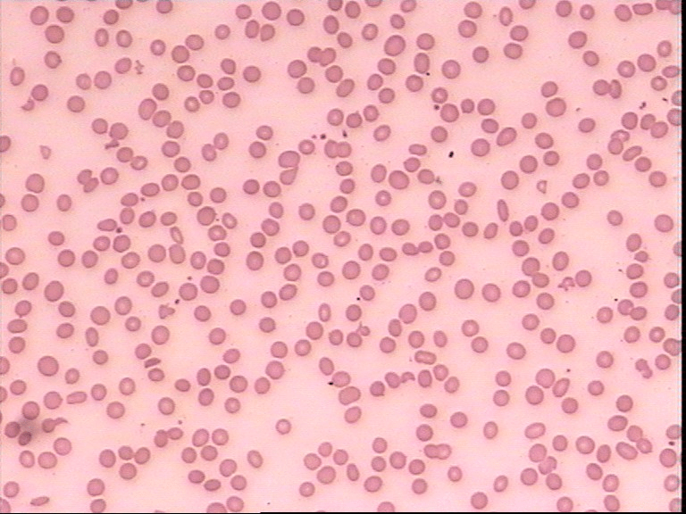 【检视界】反复胆囊结石,真凶竟是遗传性球形红细胞增多症!