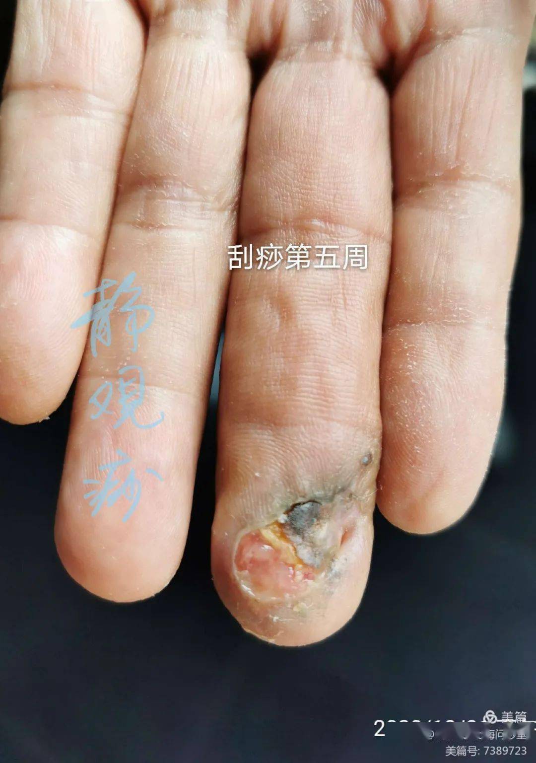李氏砭法砭治糖尿病坏疽手指