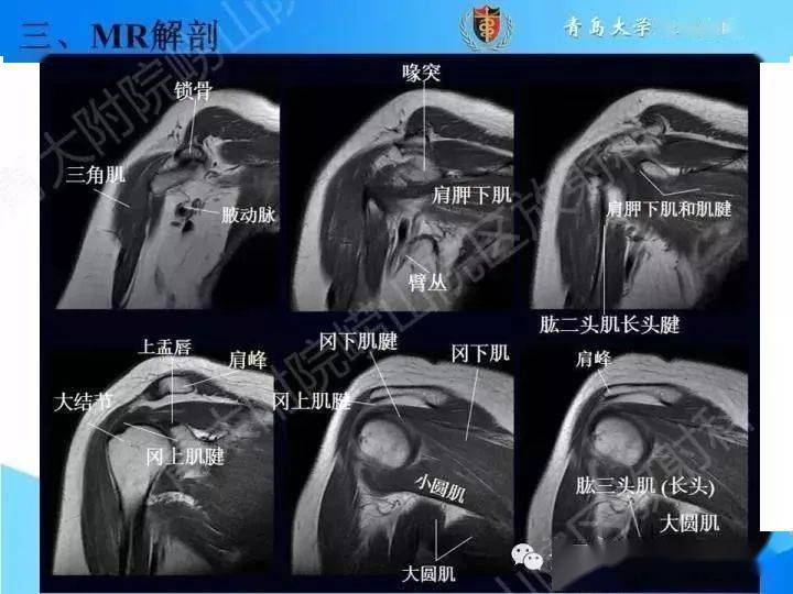 收藏:肩关节mri解剖肩袖损伤诊断技巧