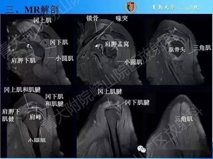 肩袖是以上4条肌腱共同组成的功能复合体,呈一个袖套状包绕肱骨头