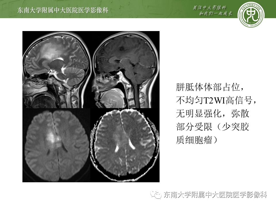 23 神经系统疾病—可逆性胼胝体压部综合征(病例1)