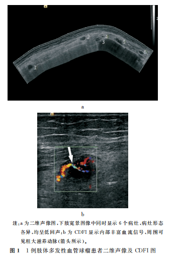 【超声专题】肢体多发性血管球瘤彩色多普勒超声特征分析