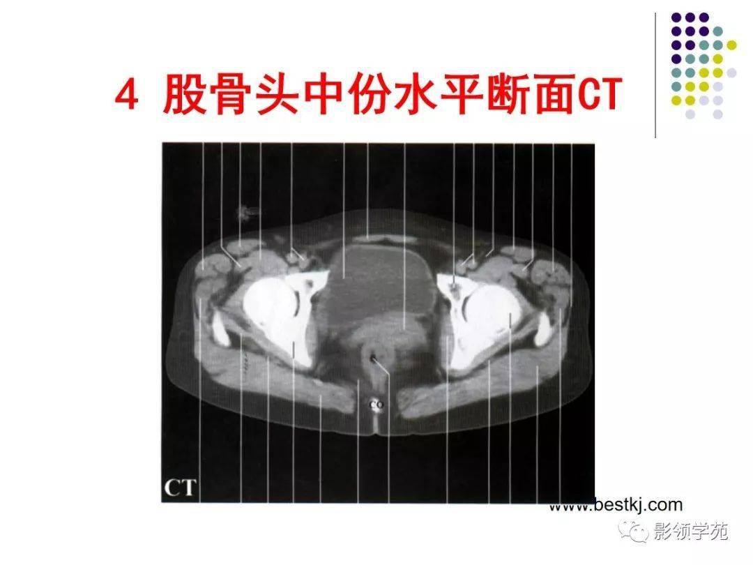 女性盆腔水平断面解剖