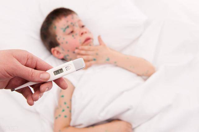 小儿水痘很凶险?注意,孩子出现这4种异常要警惕"中招"