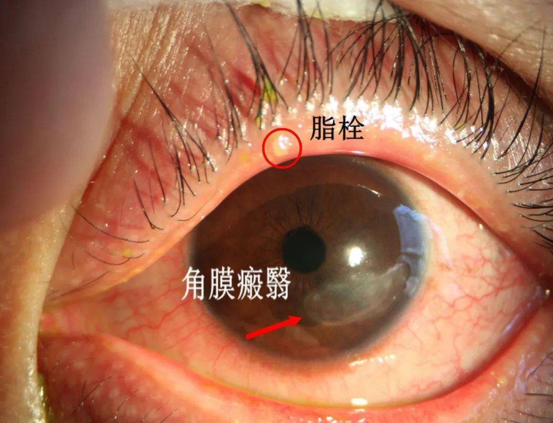 睑缘炎引起眼睛发红睑缘炎引起角膜病变瘢翳图源|科室提供另外,睑缘