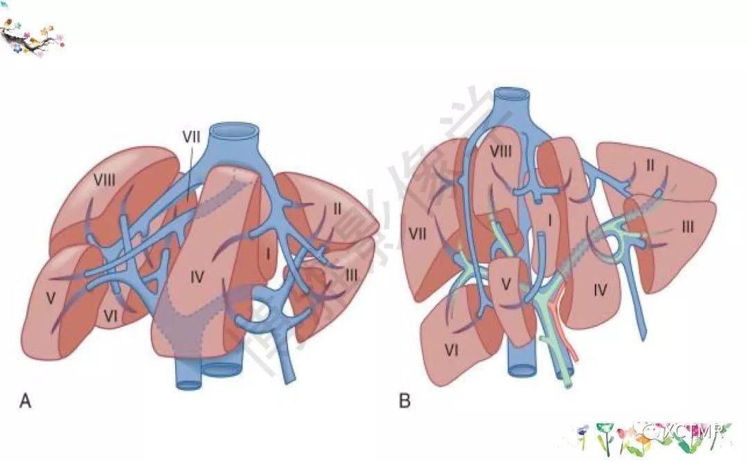 收藏丨肝脏分叶分段的影像解剖