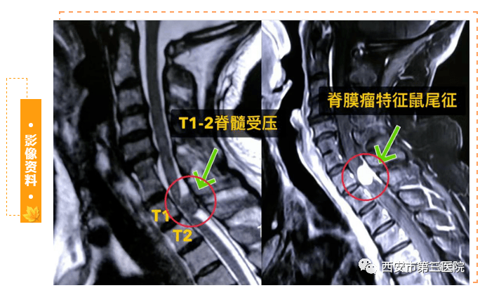 四肢麻木无力脚踩棉花感,hoffmann征阳性 0 4 腰3-4椎间盘突出髓核单