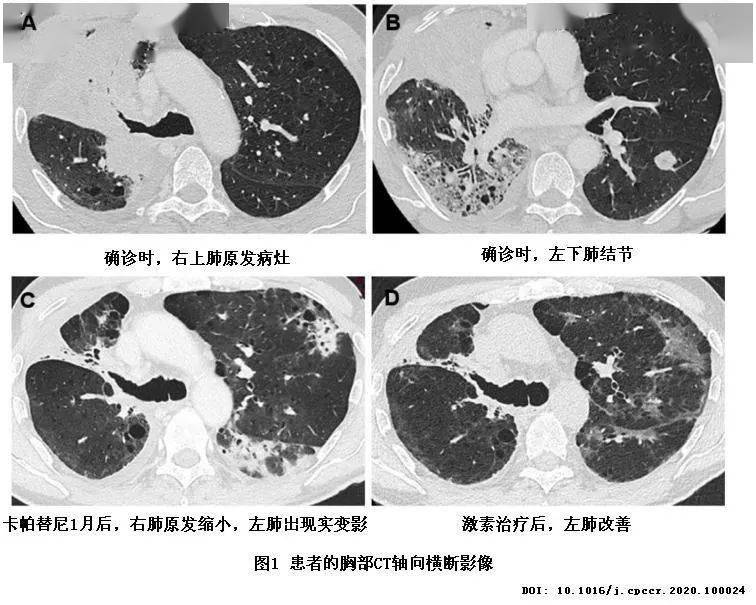 卡帕替尼(capmatinib)导致的间质性肺炎一例