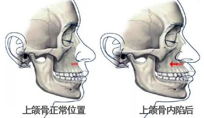 但  有些人的上颌骨天生就比较凹,这样法令纹就注定早早出现在他们