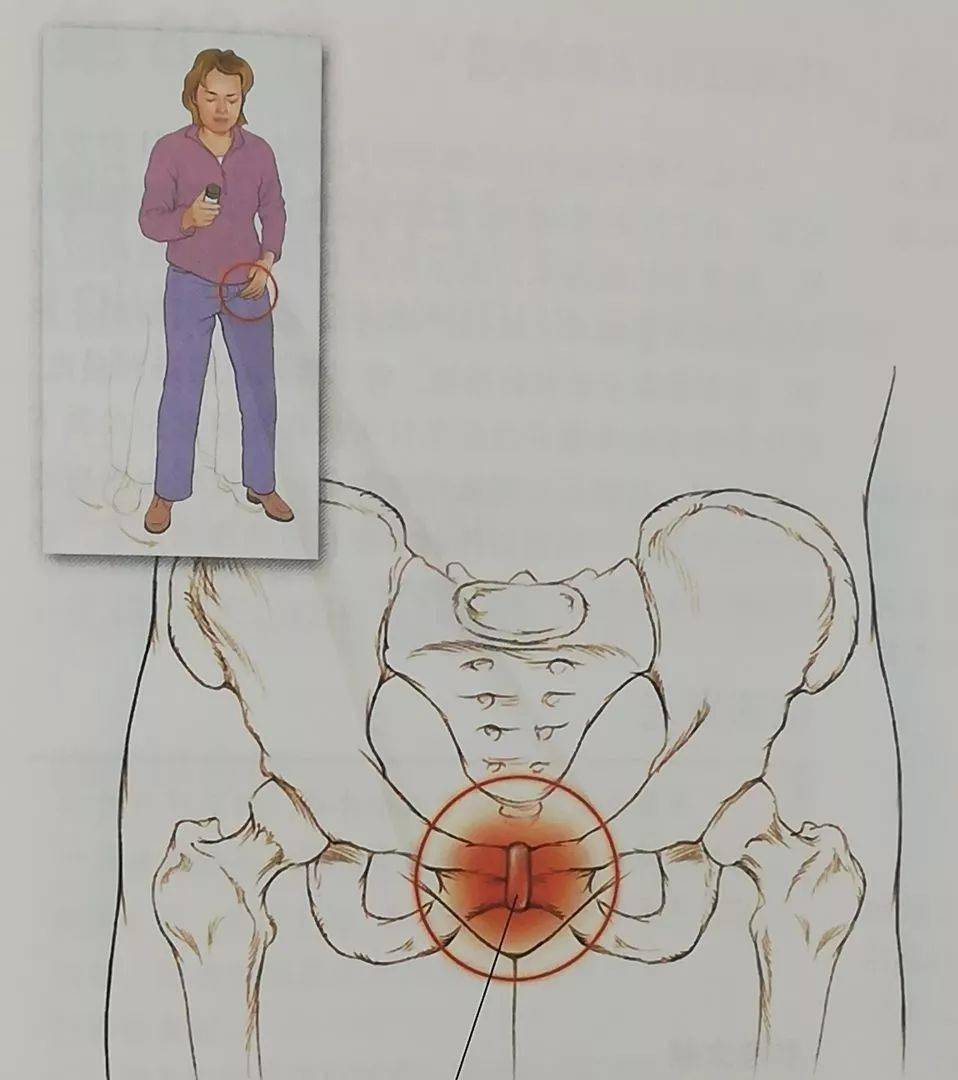 收藏 六种引起骨盆的疼痛综合征_手机搜狐网