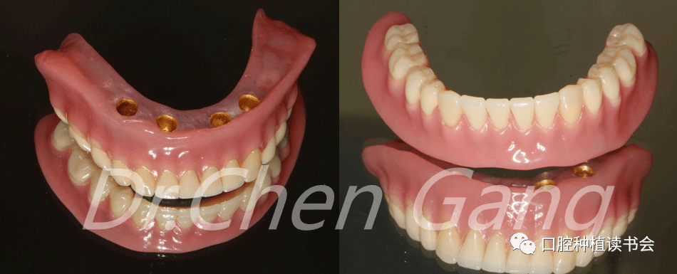 无牙颌种植大赏下颌无牙颌套筒冠固位覆盖义齿修复