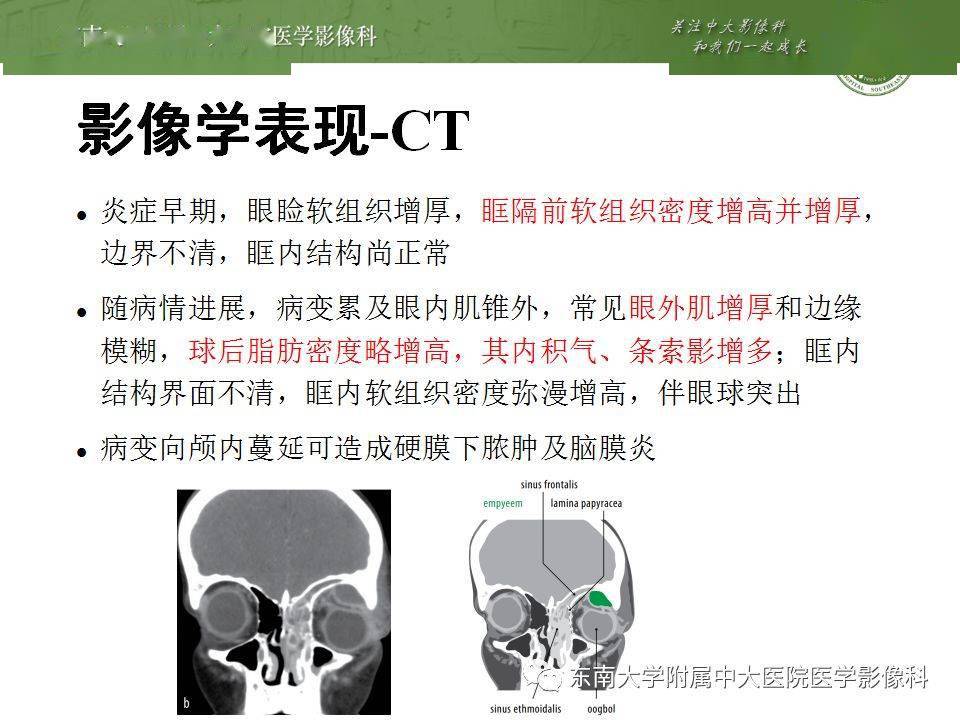 五官丨眶内蜂窝组织炎