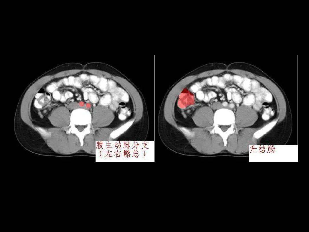 ct运用什么原理_正常肺部ct图(2)