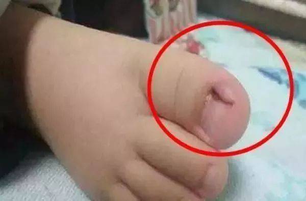 怎么解决脚指甲往肉里长 382ded03fba64084943a90c1ef915590.jpeg