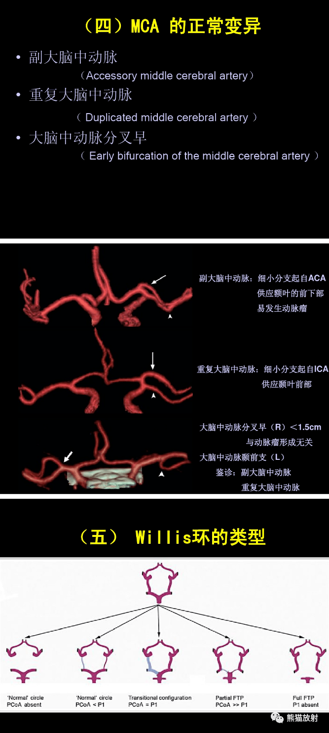 图解脑动脉的正常变异