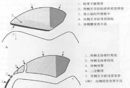 小 结:髌股关节在0～20°位(伸直位)时,髌骨大部分处在髁间沟最浅的