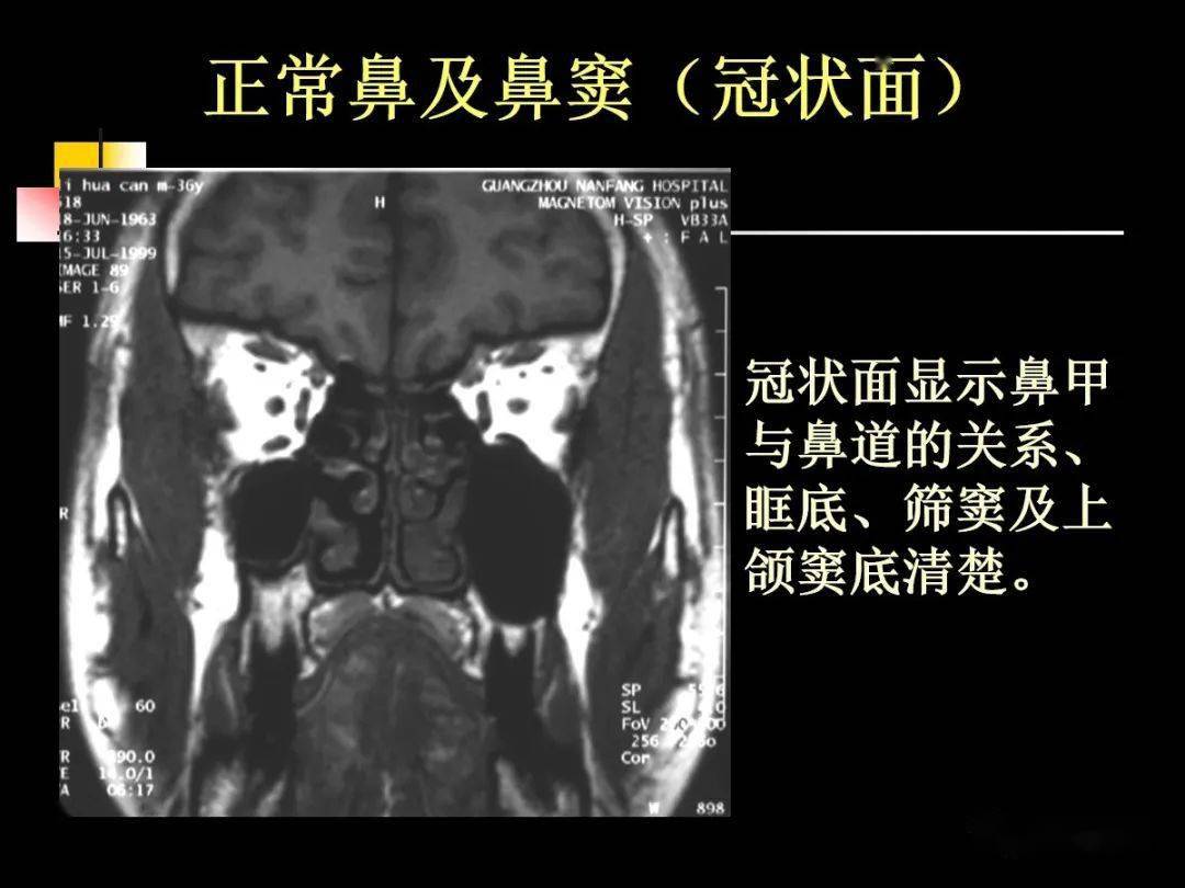 鼻及鼻窦影像解剖及相关疾病影像诊断