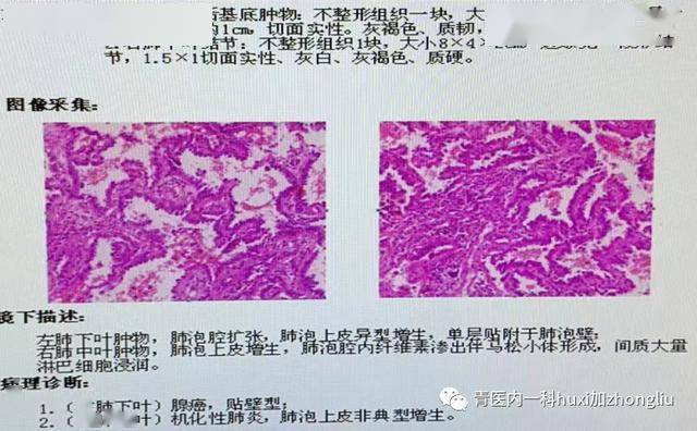 新技术青县人民医院开展肺结节手术前勾丝精准定位