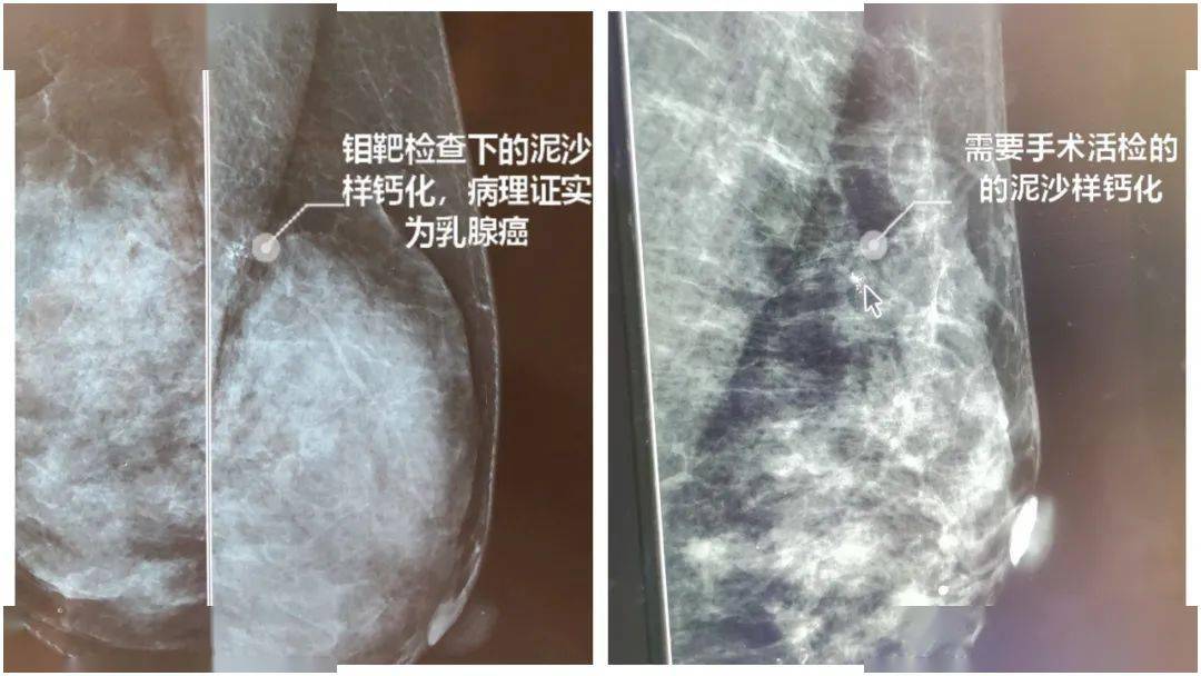 46岁的陈女士在单位常规体检时,乳腺钼靶检查发现乳腺的泥沙样钙化