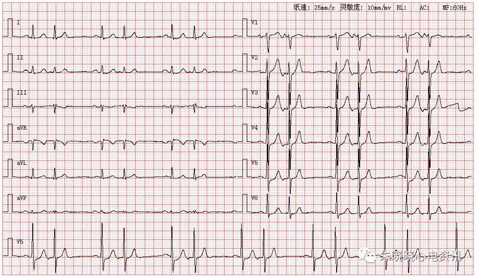 患者男,73岁,因胸闷心悸来医院就诊,图为其体检心电图