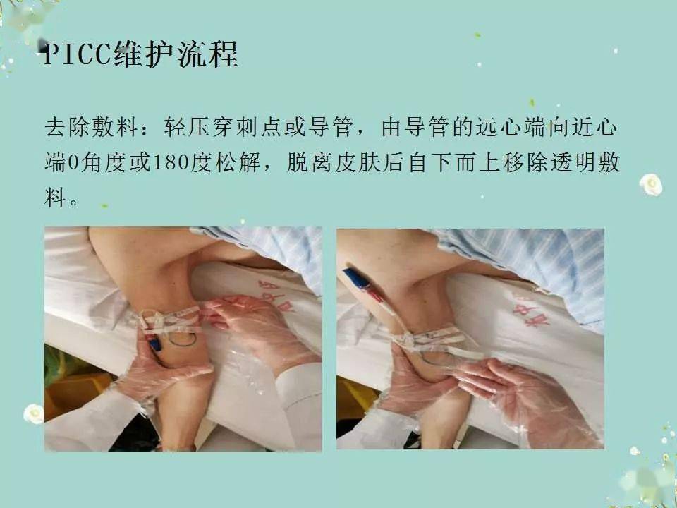 【ppt】picc导管的维护