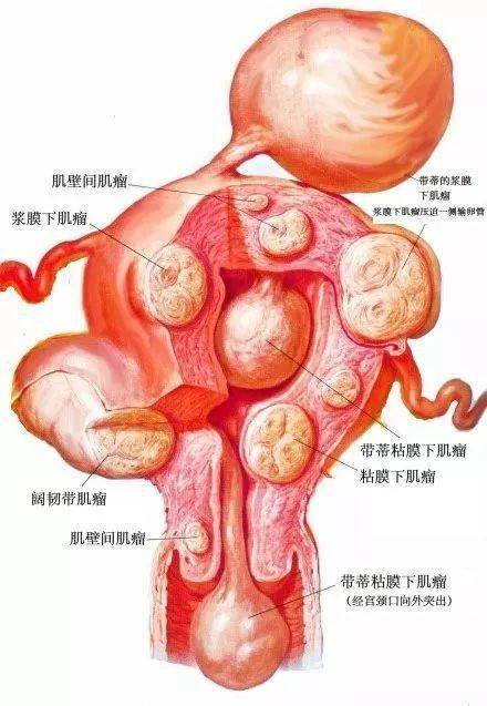 46,子宫肌瘤