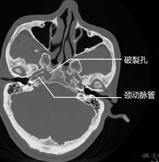 破裂孔是由蝶骨体(前方边,枕骨底部(内侧边)和岩尖(外侧边)围成的近