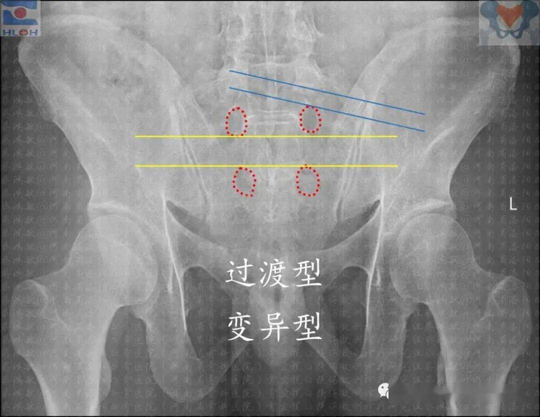 骶髂螺钉正确指向图解:通晓规律,免除错误,远离危险