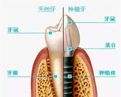 拔牙是利用什么原理_拔牙血凝块是什么样子(3)