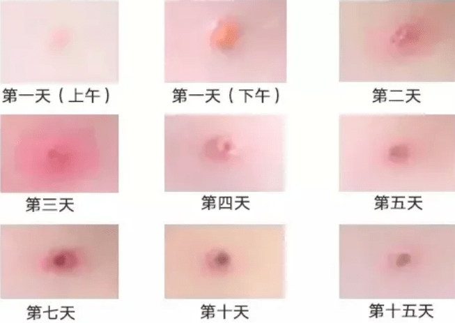 水痘如何预防?