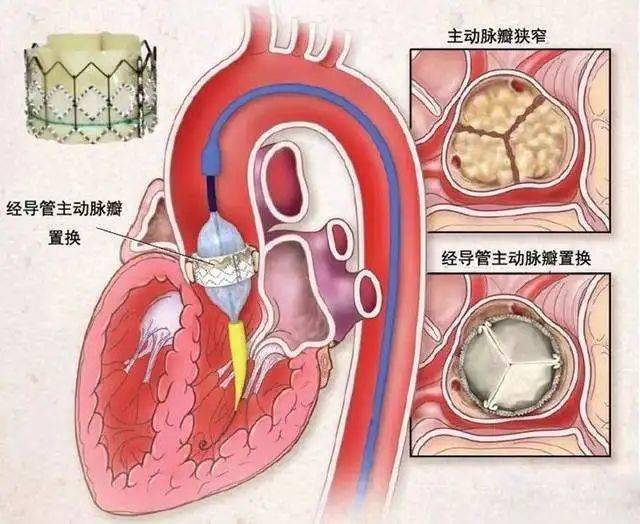 微创不开胸高龄老人更换心脏主动脉瓣