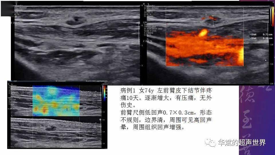 病例和文献复习:结节性筋膜炎_手机搜狐网