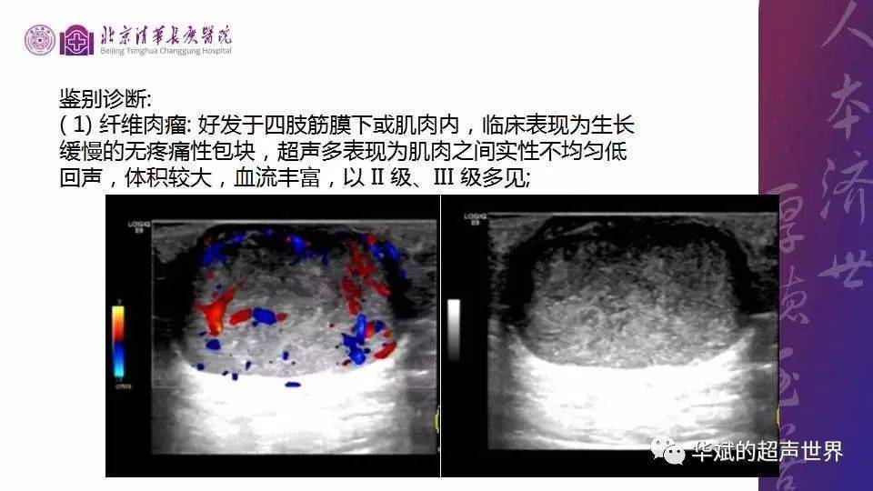 病例和文献复习:结节性筋膜炎