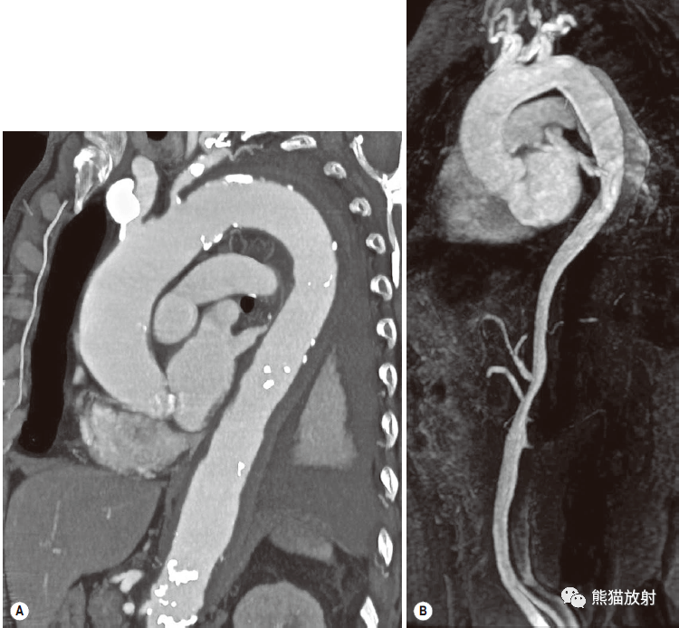 格艾选读丨获得性主动脉异常机理ct表现鉴别诊断