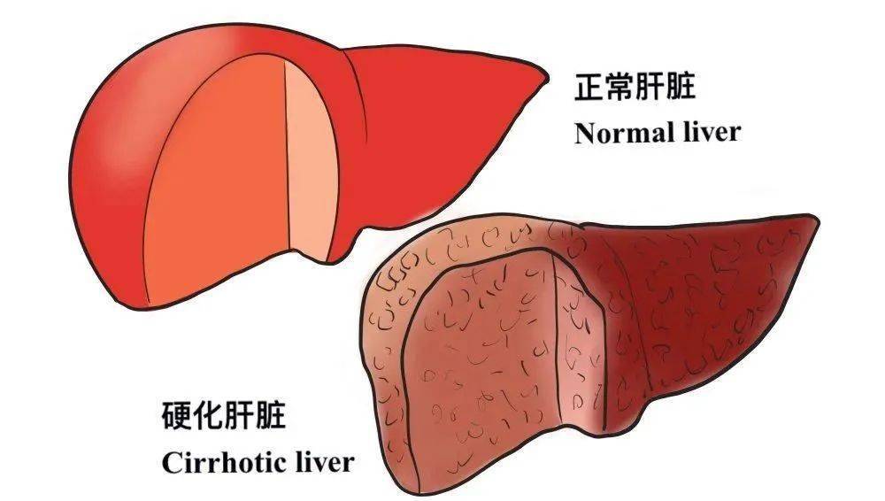 【疾病科普】从肝硬化到肝癌,身体会给你3次机会!