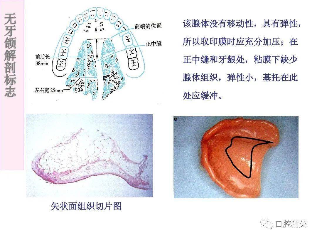 无牙颌解剖标志