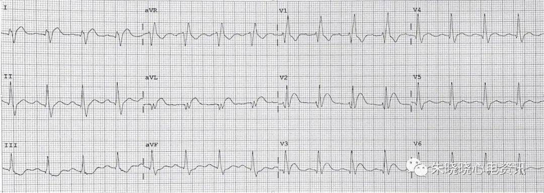 心肌缺血的心电图表现